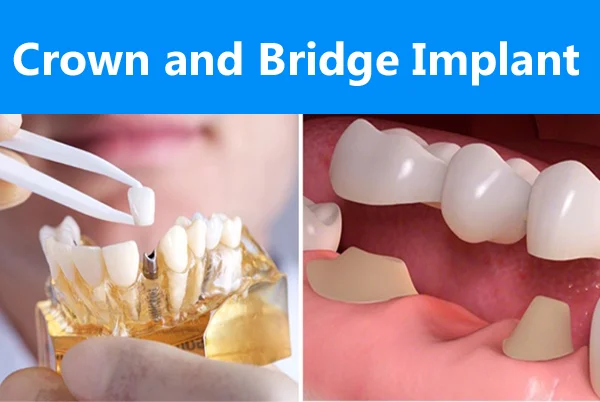Crown and Bridge Implant