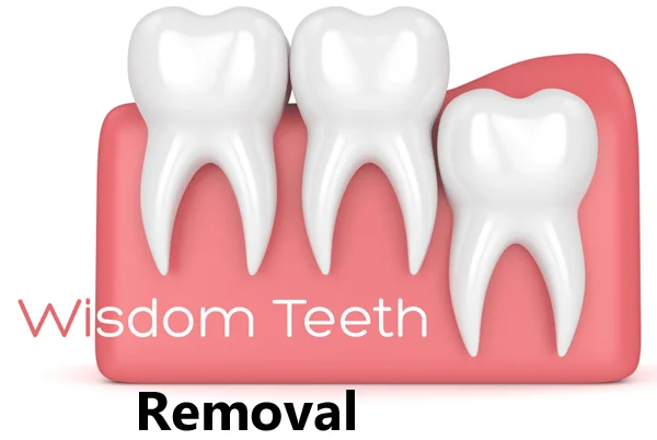 Wisdom Tooth Removal